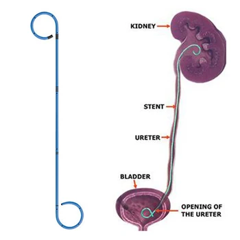 2019 Trend Ureteral Stent&double J Stent Supplier - Buy Single Ureteral ...