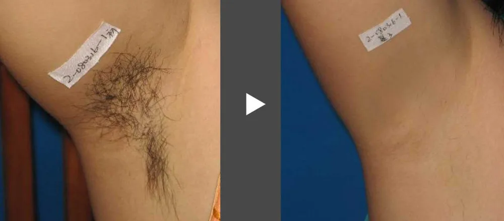808nm Diode Laser Skin Laser Hair Removal Machine For Sale