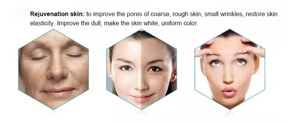 opt ipl rf nd yag best laser hair removal and skin rejuvenation machine magneto optic