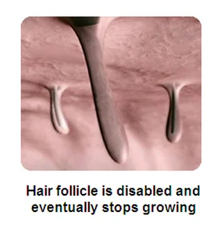 IPL SHR /SHR IPL /IPL hair removal, professional laser hair removal machine