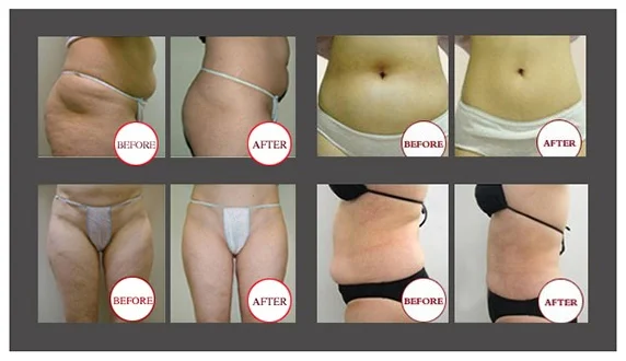 Weight loss machine anti cellulite Vacuum +Infrared Laser+RF fat cavitation salon beauty equipment for sale