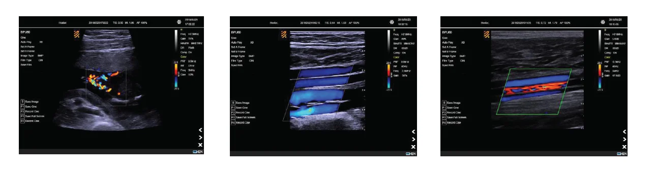 Portable Color Doppler Ultrasound System
