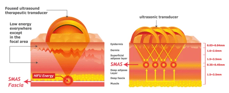 HIFU Treatment theory gram.png