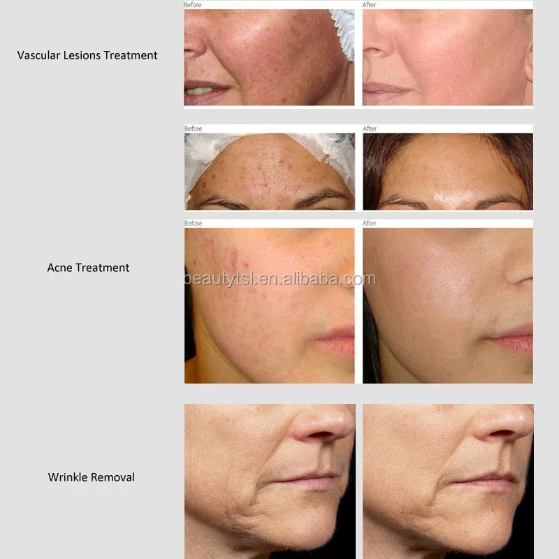 LINGMEI ipl hair removal electrolysis machine,SHR IPL/painless hair removal SHR IPL machine