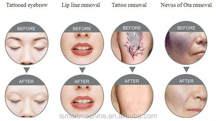 tattoo-removal-.jpg