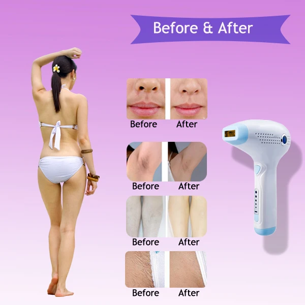 personal hair removal