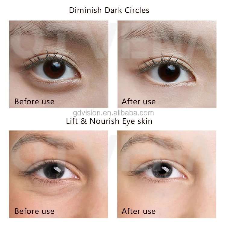 eye bag cream before and after