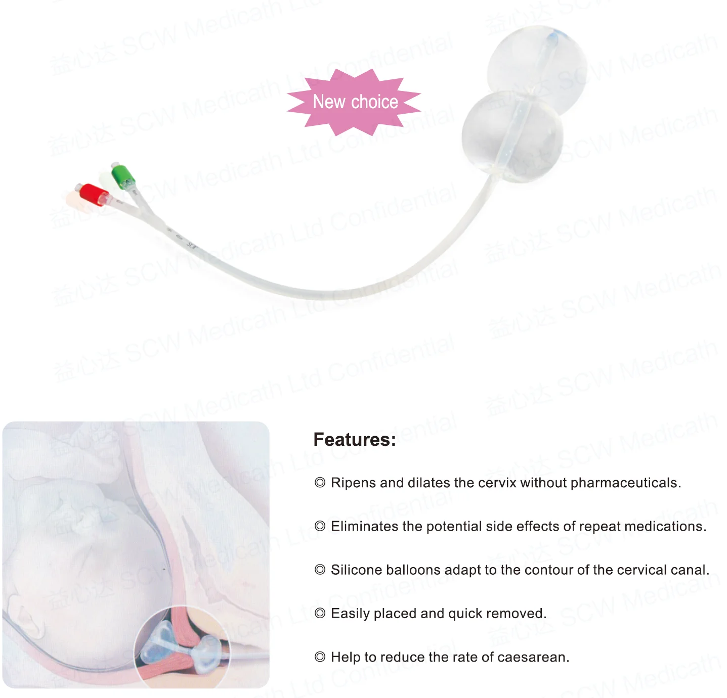 Disposable Cervical Ripening Balloon Promote The Cervix Ripening Help ...