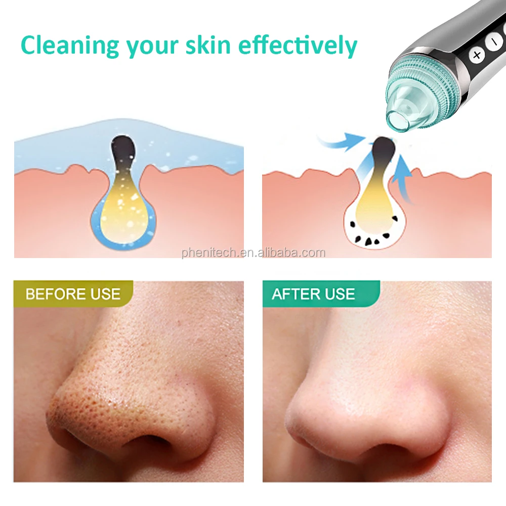 blackhead remover