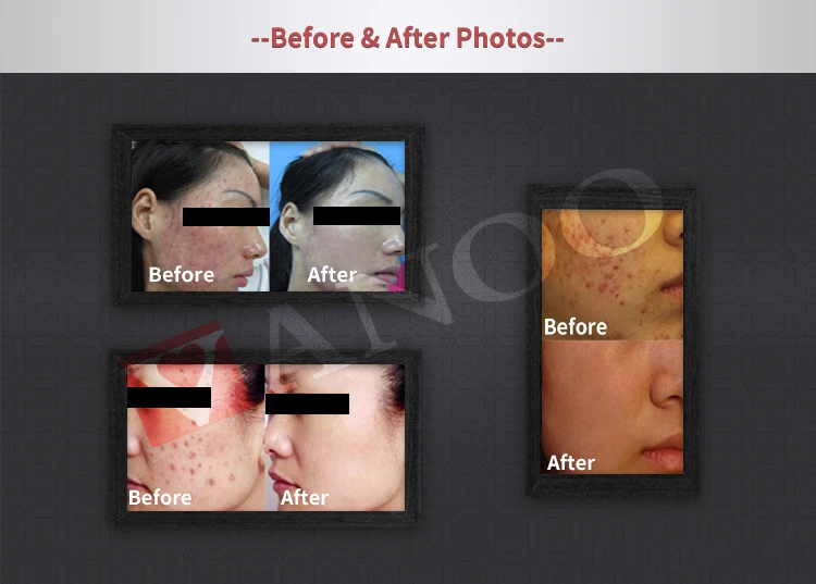 ISO13485 approval PDTLED facial and whole body skin rejuvenation Acne treatment beauty machine/pdt led photo rejuvenation