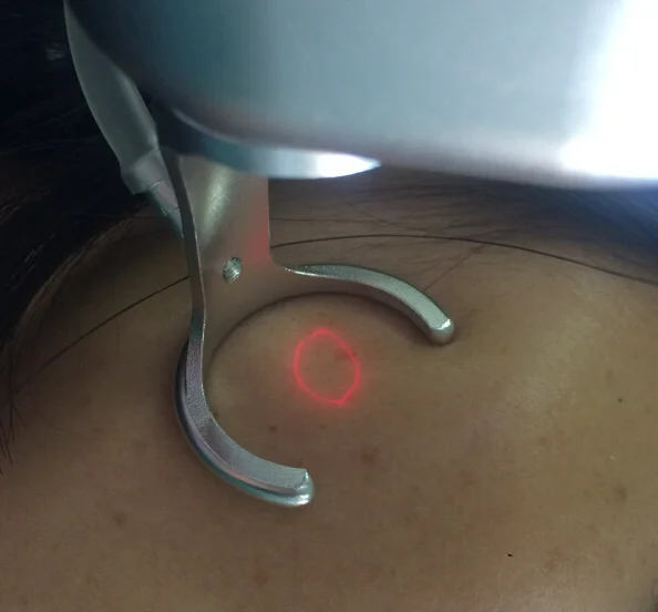 Medapolo fractional CO2 laser dermatology HS-411