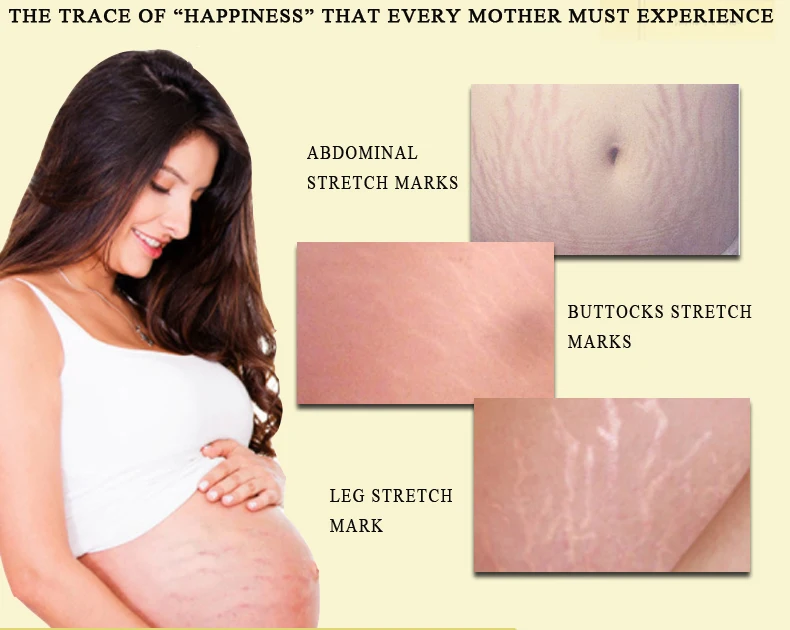 cara menggunakan oedo rose remove stretch mark cream