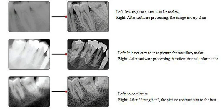 CE Approved Golden Color Digital Dental X-Ray Imaging System/YES Intraoral Sensor