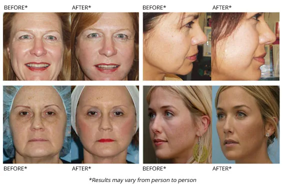 thread-lift-before-and-after-photos