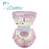 Hot sales Educational Half metal Half Ceramic Bracket Dental Orthodontic Model for Patient Communication
