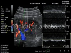 Ultrasound Cart Medical Equipment Portable Scanner