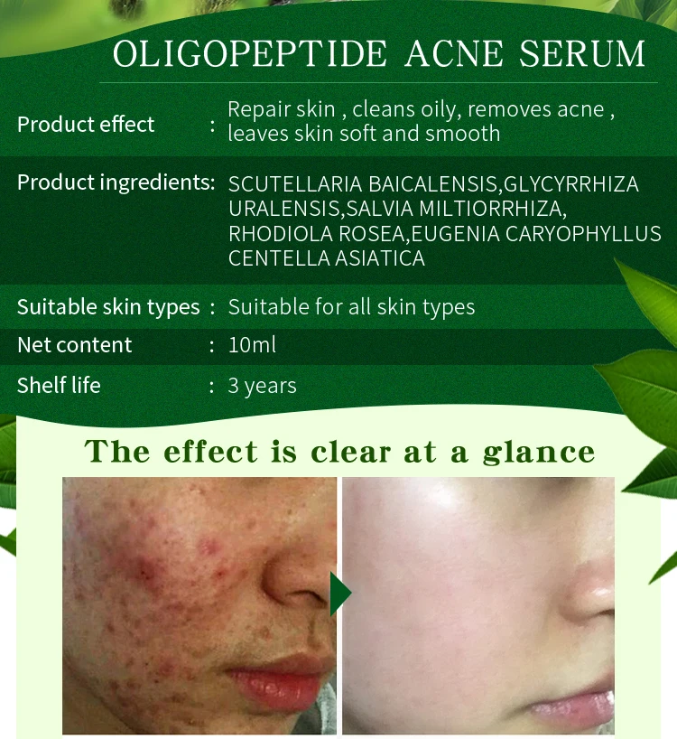 strong acne treatment