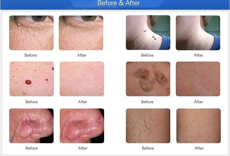 Factory price laser diode 980nm spider vein removal Blood vessel laser vein removal vascular machine