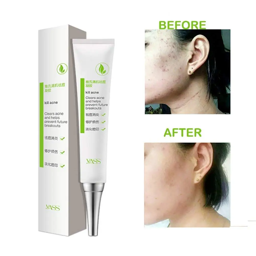 anti acne scar