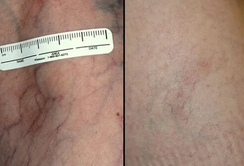 veins removal (2)