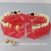 Caries treatment model before &after