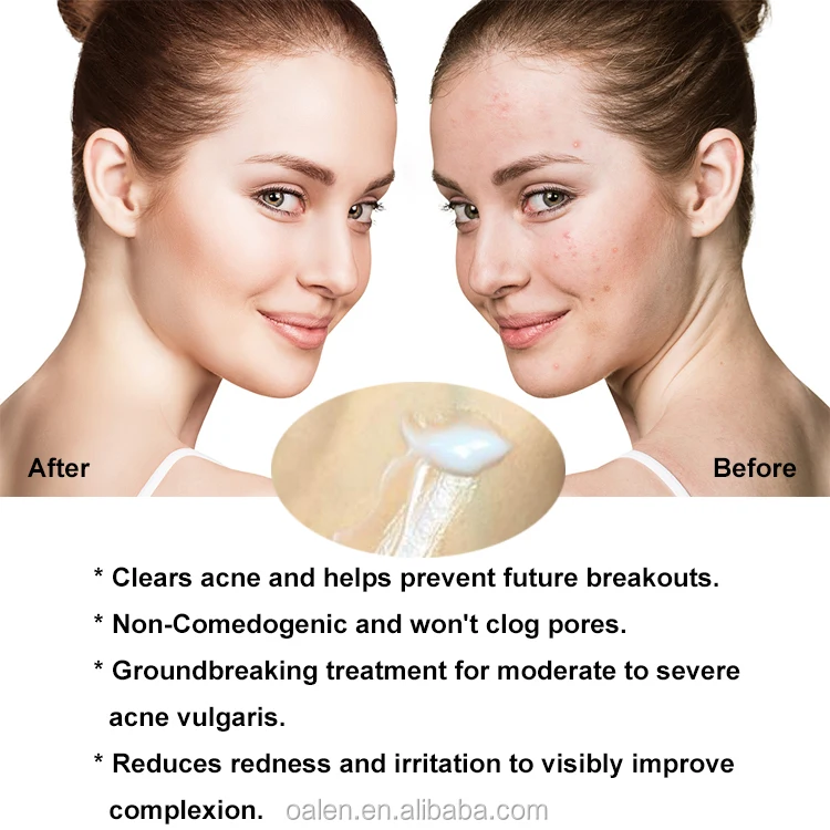 best herbs for acne scars