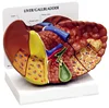 Human liver cancer diseased model