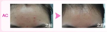 ipl hair removal beauty equipment new product.png