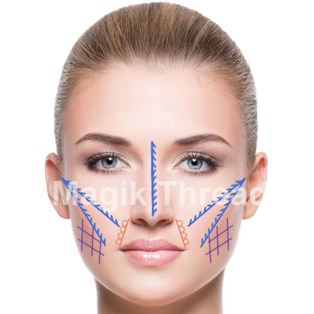 Pdo threads nasolabial folds opecauthentic