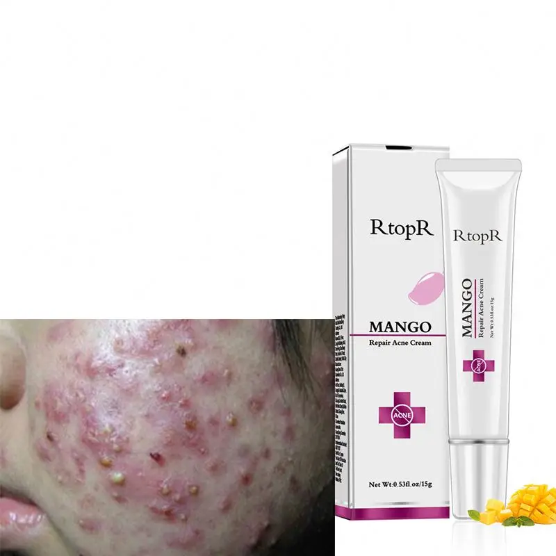 Best Natural Organic Skin Care Product with Tea Tree Oil & Vitamin E Pimple Removal Acne Scar Treatment Day Cream Wholesale