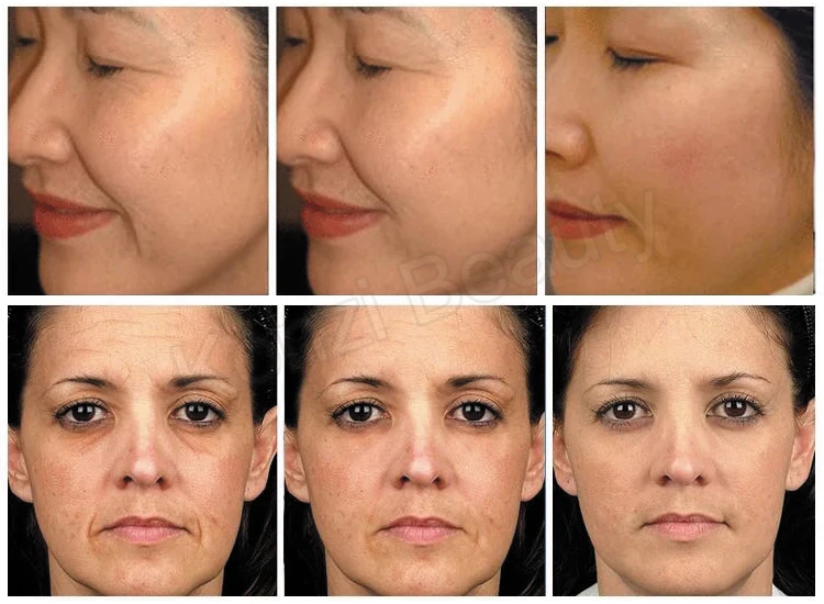 High quality hifu v-max anti aging beauty machine/hifu v-max for face lifting wrinkle removal