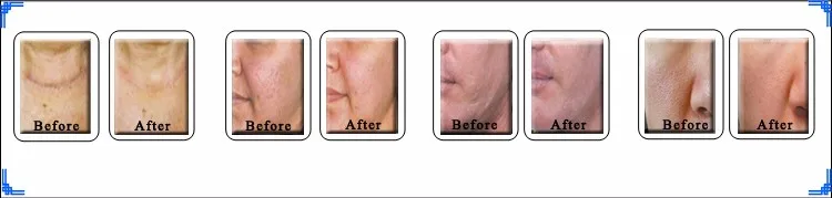 Er: glass laser age spot removal skin treatment beauty machine.jpg