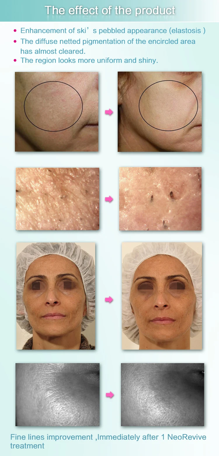 Korea Technology Facial Moisturizing Deep Cleansing Dead Skin Remover for Face Machine