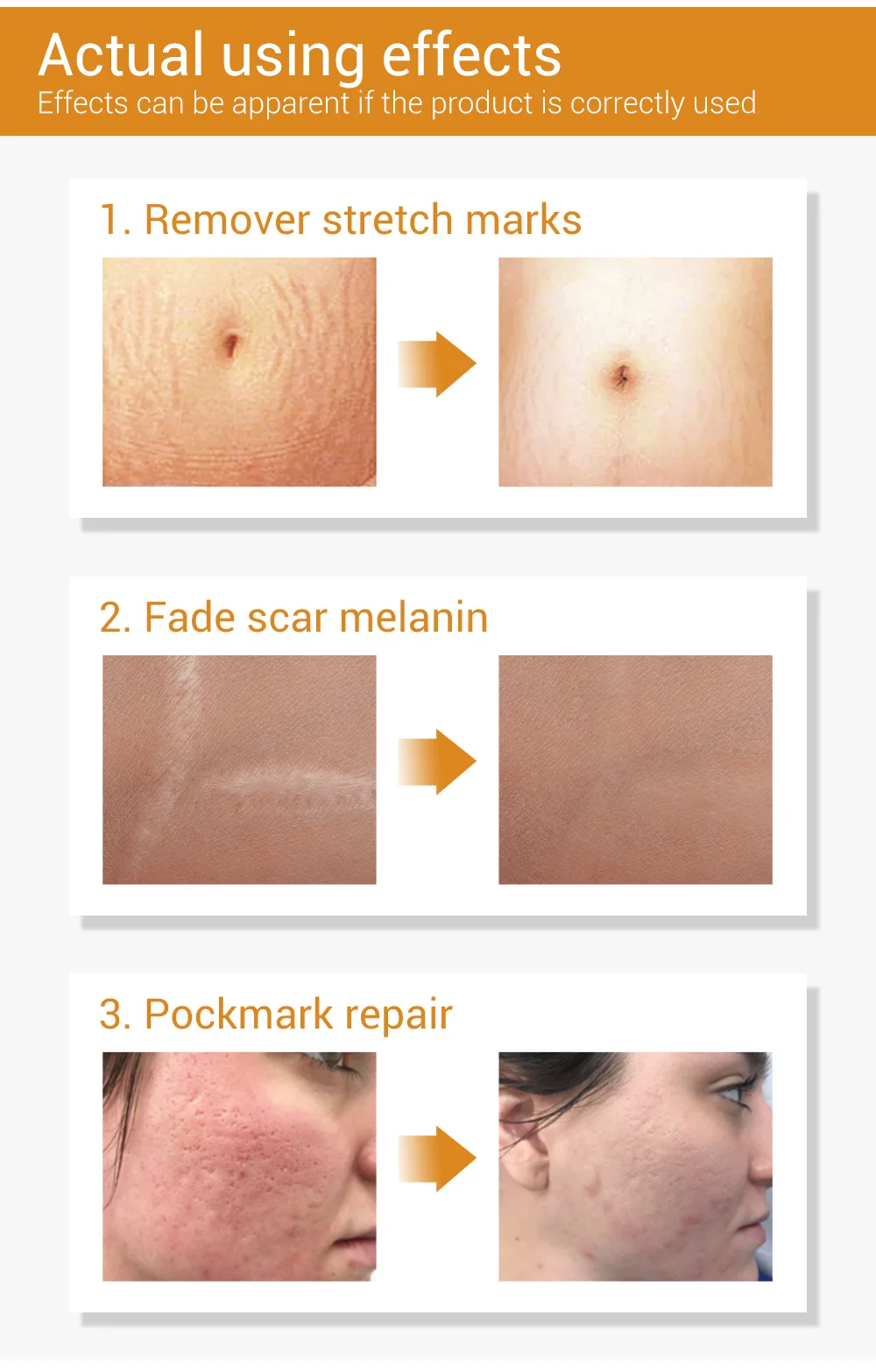 LANBENA scar removal serum stretch mark remover