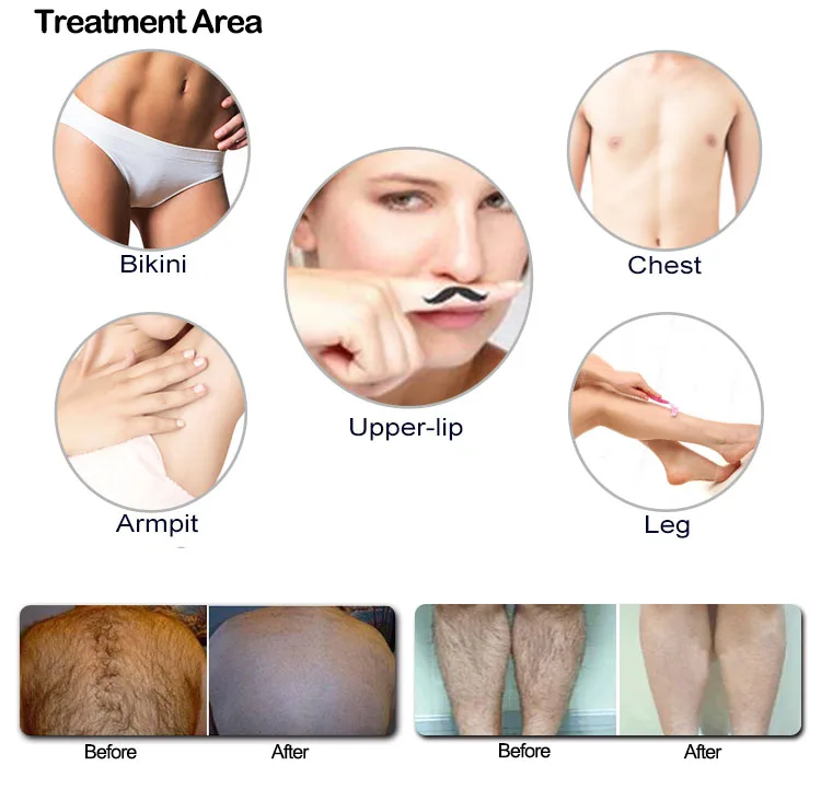 Hottest Sale Portable 808nm Diode Laser Hair Removal Machine