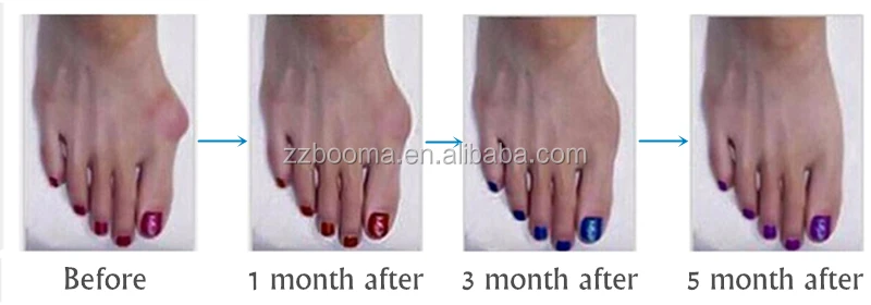 Gel silicone toe separator