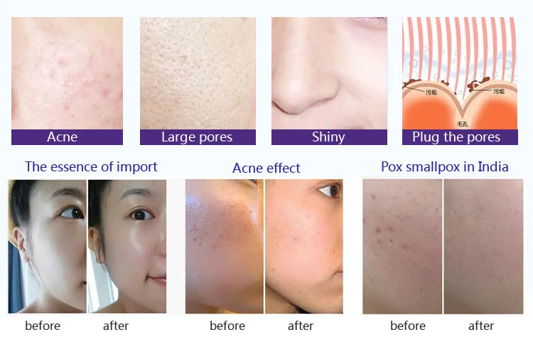 Factory sale meso pen ultima microneedling pen for personal use