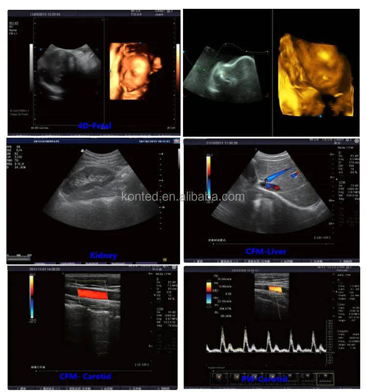 How is a doppler ultrasound performed?