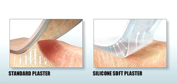 keloid 去除医用粘合剂 parches de silica para cicatrices