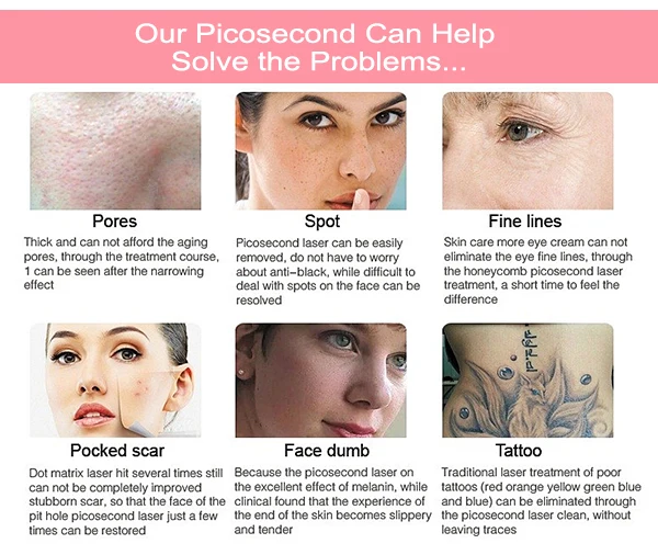 CE Certificate Cynosure Picosecond nd yag laser 755nm 532nm 1064nm wevalength for all color tattoo birthmark removal Picosure 