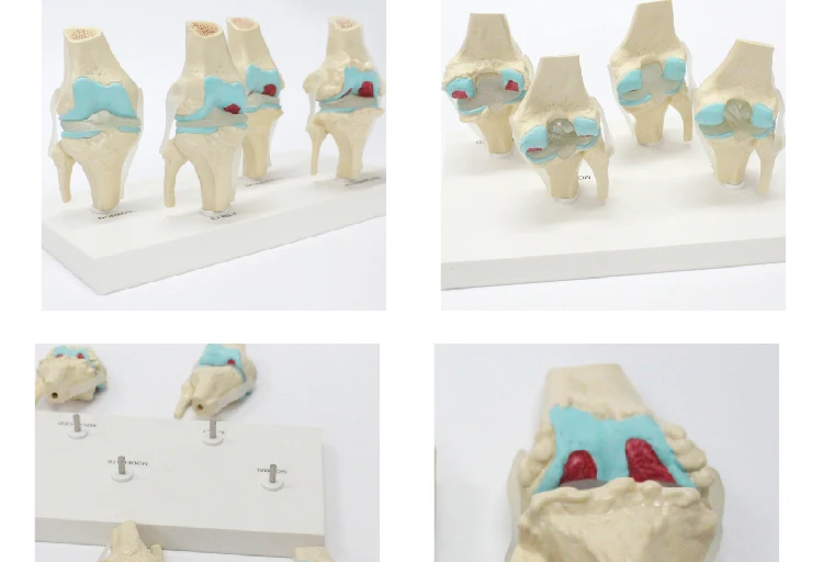 4 Stage Osteoarthritis Knee Model - Educational Tool