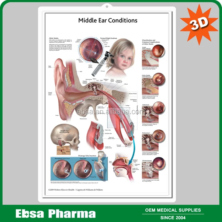 3d Medical Human Anatomy Wall Charts Poster Middle Ear Conditions