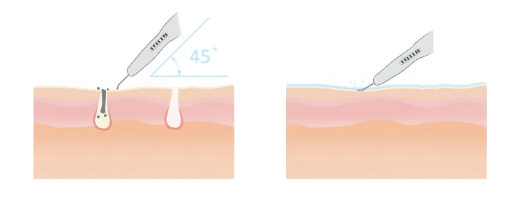 Hydrofacials Oxygen And Water Jet Peel Skin Hydropeels Tips Hydrapeel