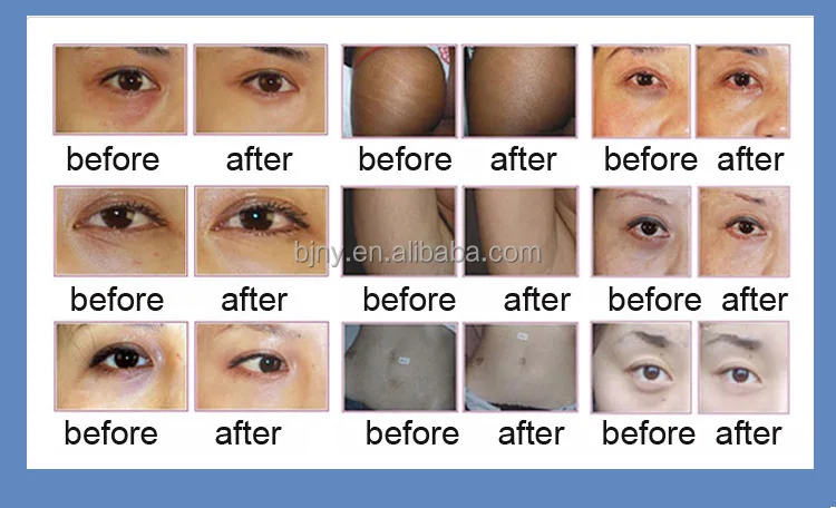 carboxy under eye treatment