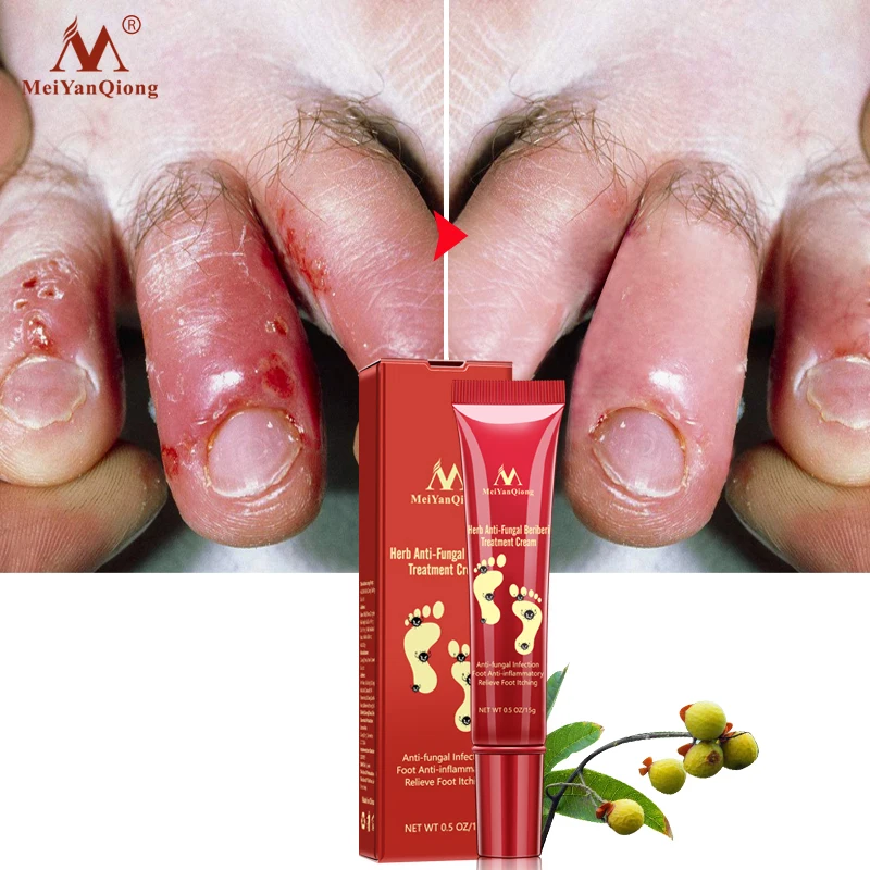 

Herb Nail Fungus Treatment Anti-fungal Infection Foot Anti-inflammatory Onychomycosis Chinese Toe Nail Treatment Cream, White