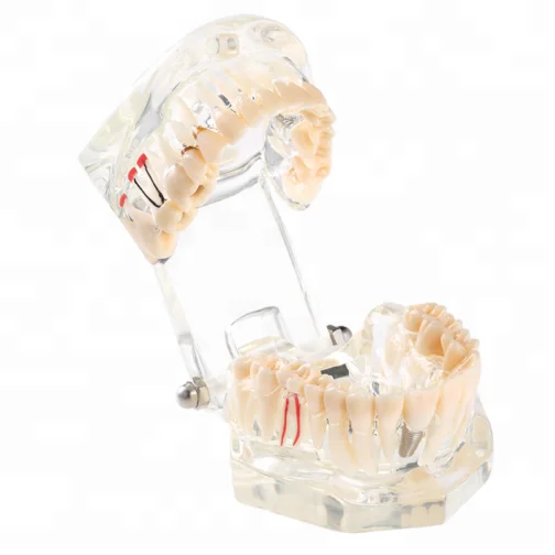 
Hot Sale Resin Dental Implant Model 