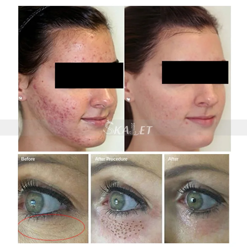 2019 Skin Tightening Non-invasive jet plasma 2 in 1face lifting from China