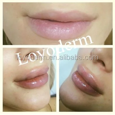 

best selling BDDE injectable hyaluronic acid dermal filler with ce in china, Transparent