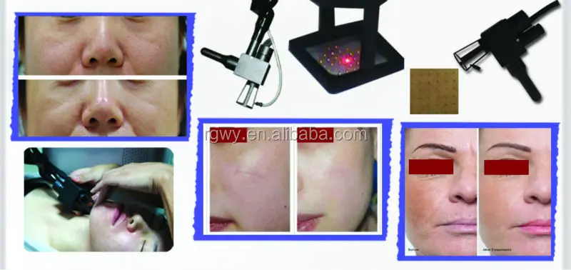 fractional co2 laser equipment