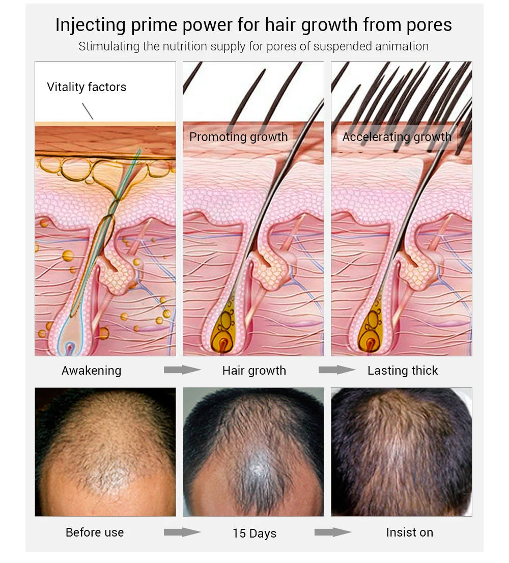 Lanbena Natural Hair Growth Essence Spray For Bald Head Buy Hair